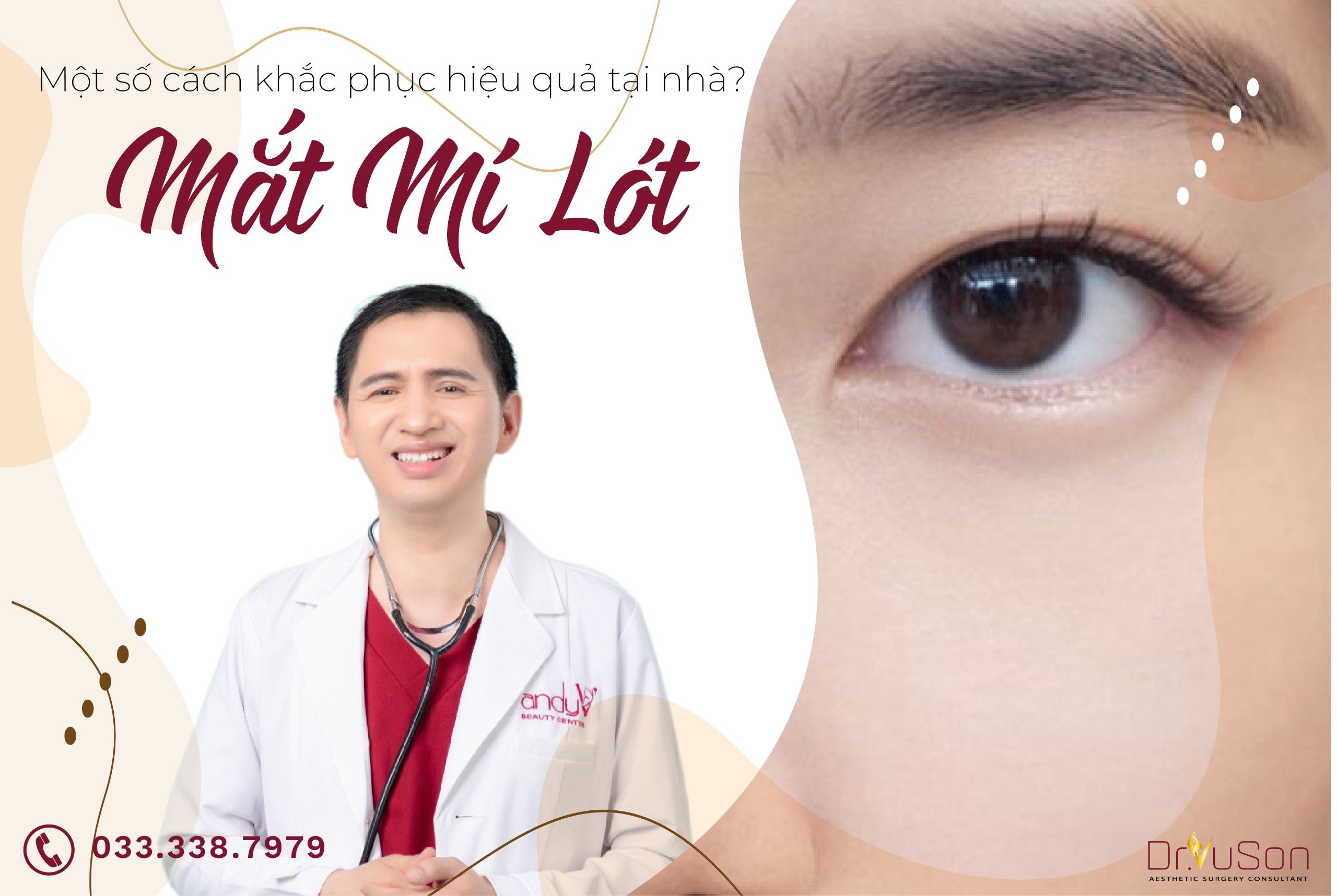 Mắt mí lót là như thế nào? Cách khắc phục mắt mí lót tại nhà?