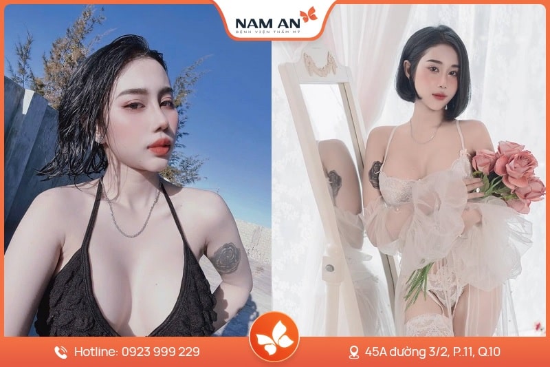 Nâng ngực nội soi không chạm