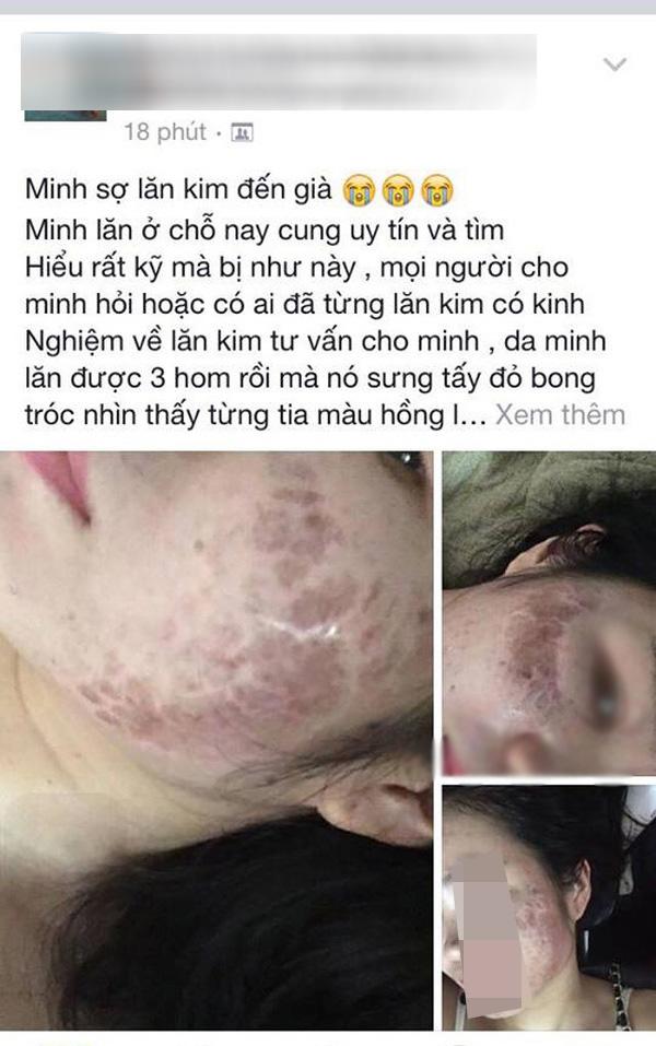 Tưởng da căng mịn sau lăn kim, cô gái gây sốc toàn tập với khuôn mặt chi chít mụn mảng