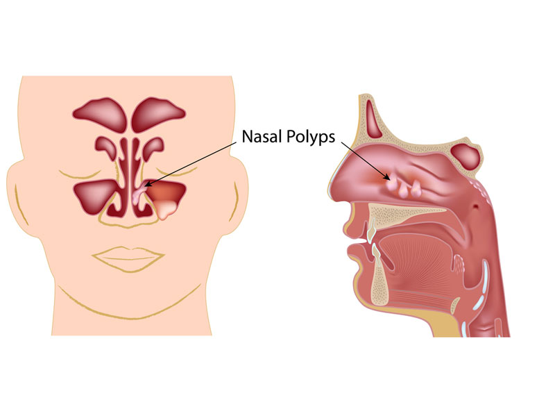 Những thông tin cần biết về tình trạng Polyp mũi