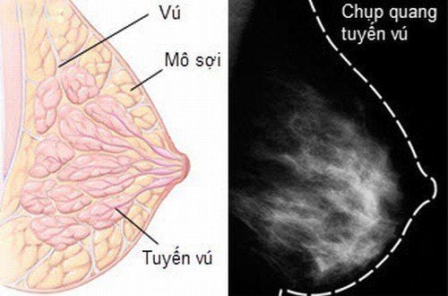 Nhận biết một số bệnh lành tính phổ biến ở tuyến vú