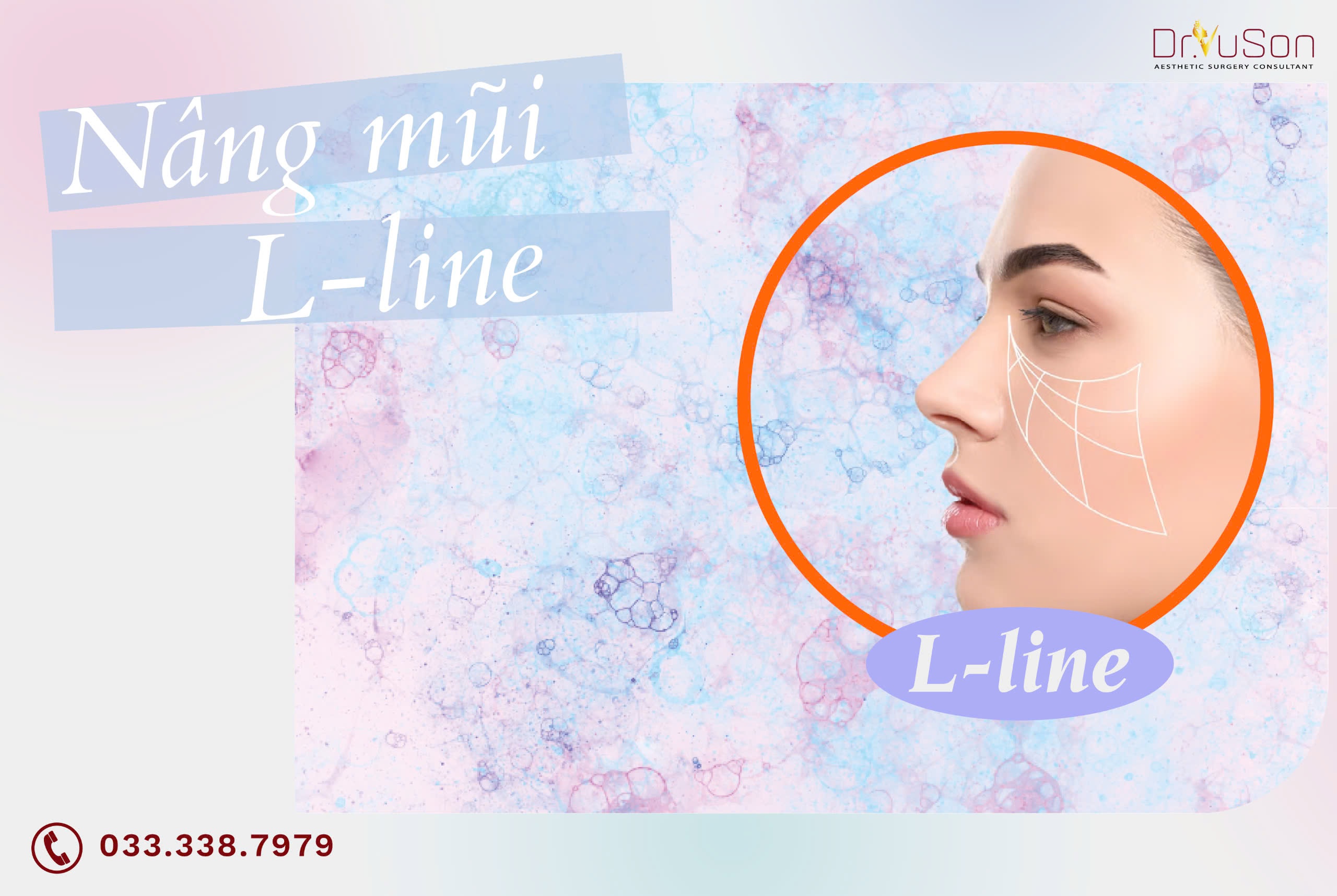 Nâng mũi L-line: Tất cả những điều bạn cần biết