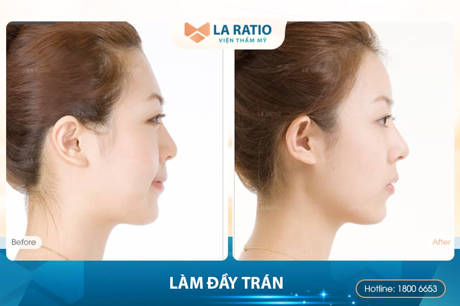 Trán lõm là gì? Làm sao khắc phục tình trạng lõm trán