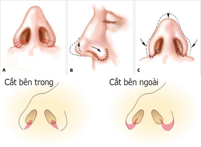 Thu gọn cánh mũi là gì? Giải pháp giúp cho gương mặt hài hòa, tự nhiên