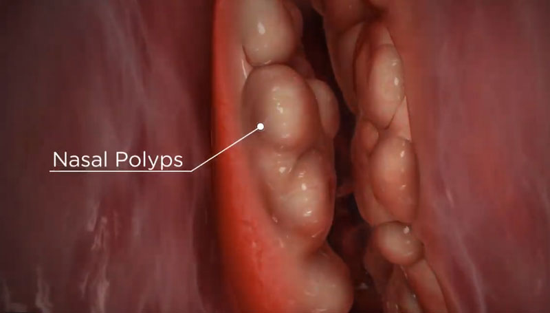 Những thông tin cần biết về tình trạng Polyp mũi