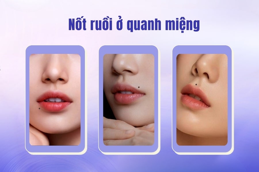 Giả mã nốt ruồi ở miệng tốt hay xấu? Có nên tẩy không?