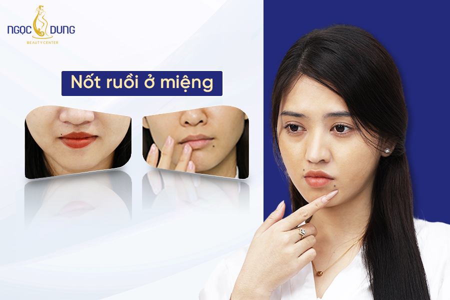 Giả mã nốt ruồi ở miệng tốt hay xấu? Có nên tẩy không?