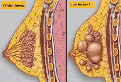 Nhận biết một số bệnh lành tính phổ biến ở tuyến vú