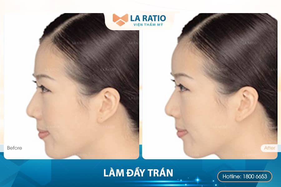 Trán lõm là gì? Làm sao khắc phục tình trạng lõm trán