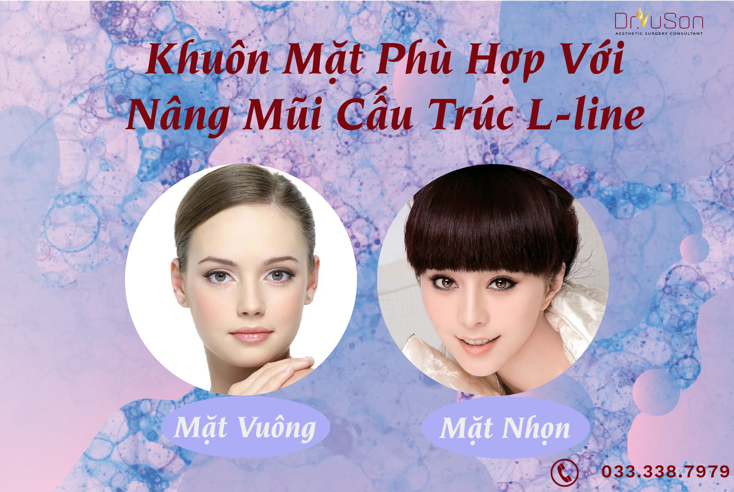 Nâng mũi L-line: Tất cả những điều bạn cần biết