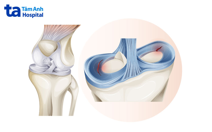 Sụn là gì? Cấu tạo, vị trí, chức năng của mô sụn với cơ thể người