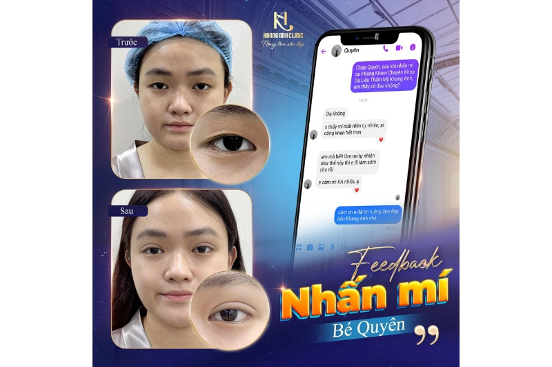 Review nhấn mí plasma tại Phòng khám Khang Anh Quận 12