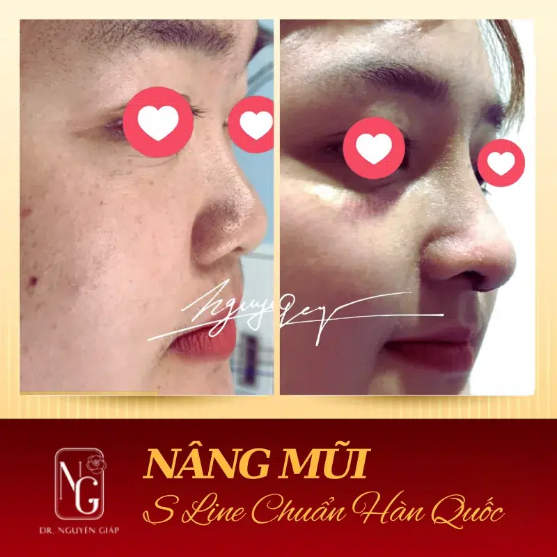 Nâng mũi S-line Hàn Quốc