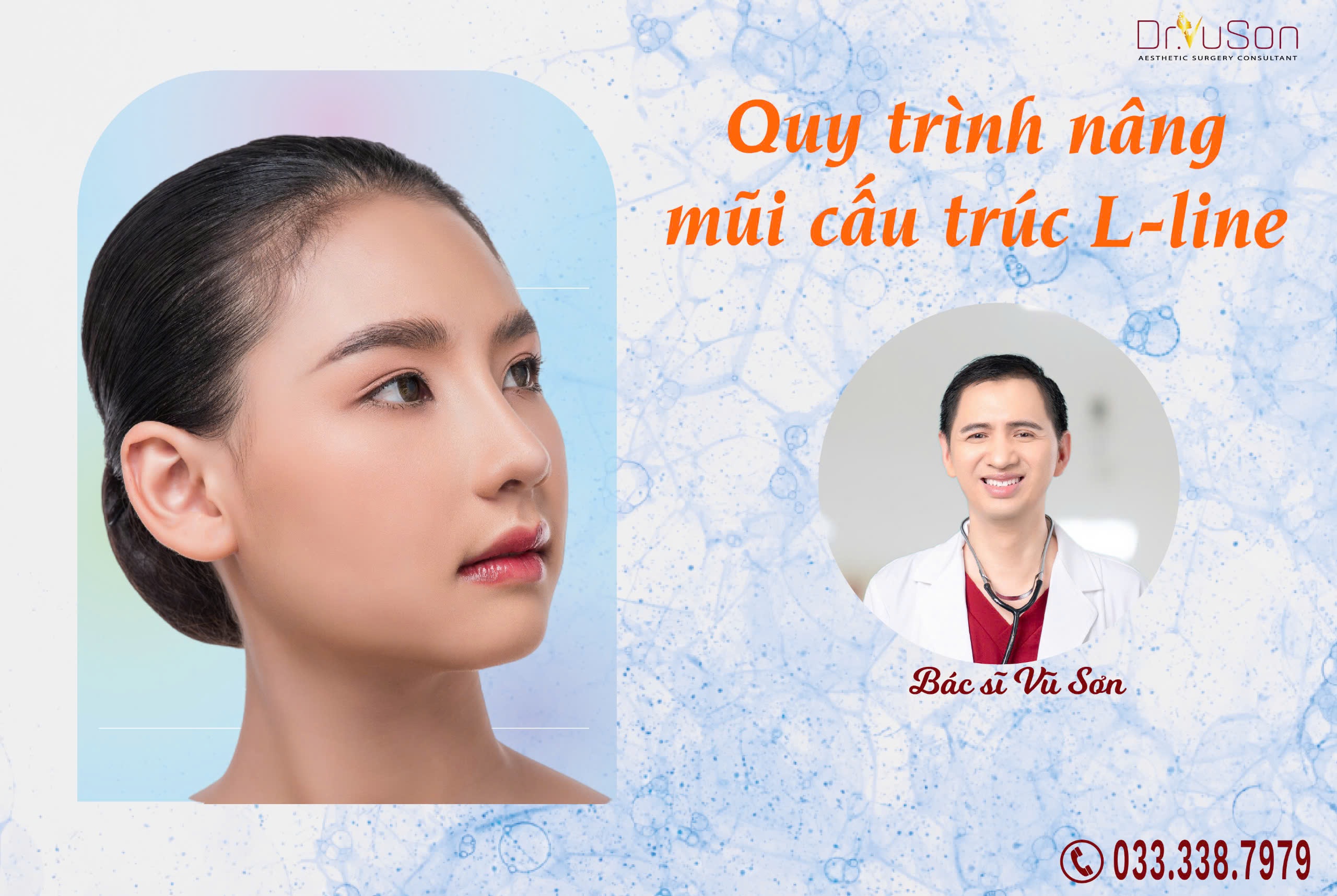 Nâng mũi L-line: Tất cả những điều bạn cần biết