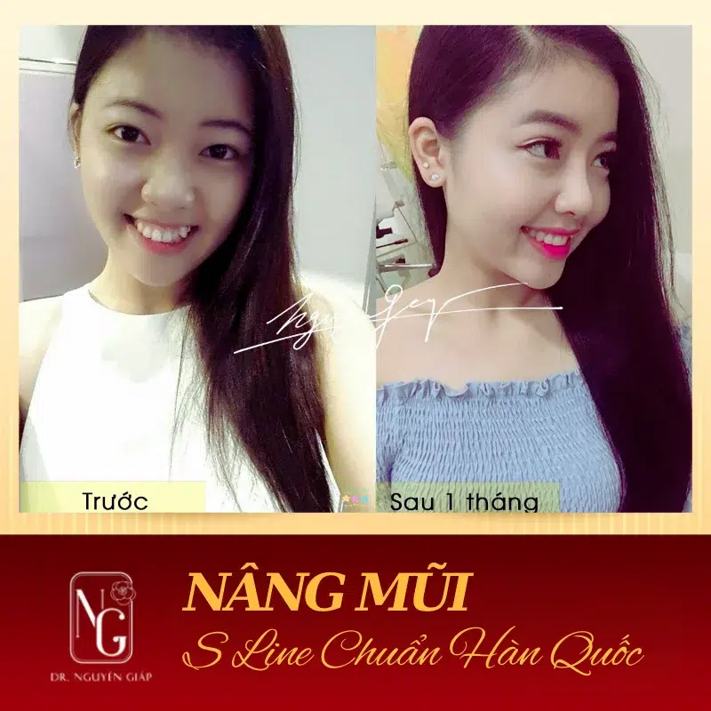 Nâng mũi S-line Hàn Quốc