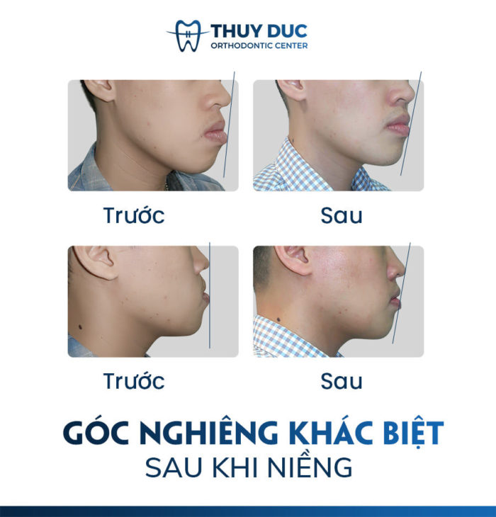 Niềng răng móm có đắt không? Hết bao nhiêu tiền?