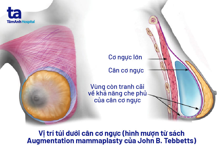 Đặt túi ngực: Chỉ định, quy trình và lưu ý quan trọng