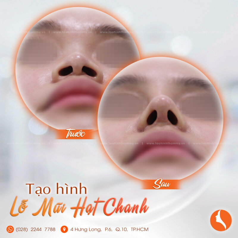 Lỗ mũi hạt chanh là như thế nào? Cách để sở hữu lỗ mũi hạt chanh đẹp tiêu chuẩn