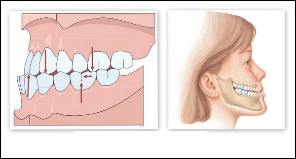 Niềng răng móm có đắt không? Hết bao nhiêu tiền?