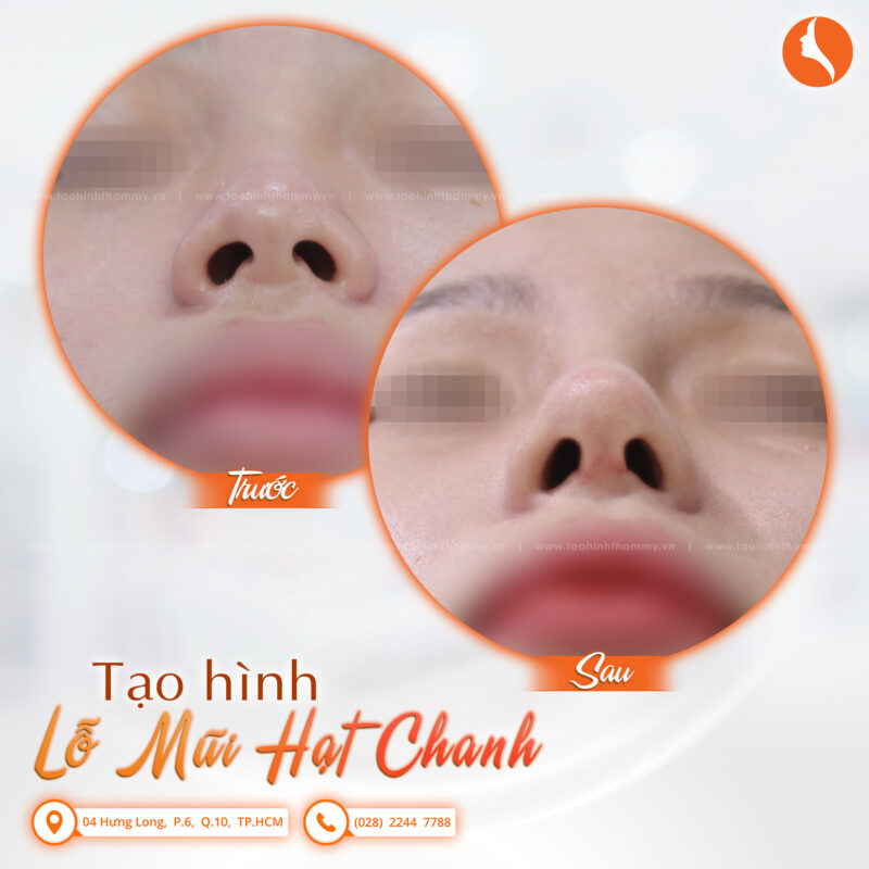 Lỗ mũi hạt chanh là như thế nào? Cách để sở hữu lỗ mũi hạt chanh đẹp tiêu chuẩn