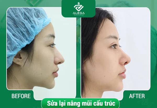 Nâng mũi bao lâu thì đầu mũi mềm? Biện pháp cải thiện tình trạng này là gì?