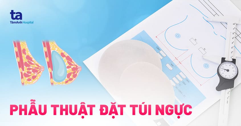 Đặt túi ngực: Chỉ định, quy trình và lưu ý quan trọng