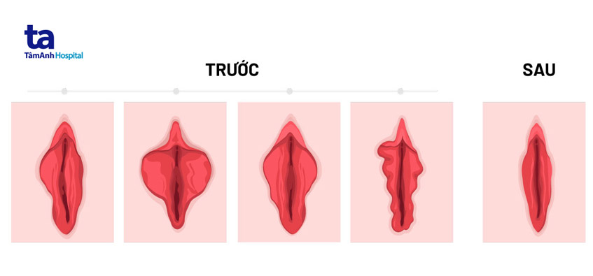 Môi lớn là gì? Cấu tạo, vị trí và chức năng đối với cơ thể phụ nữ