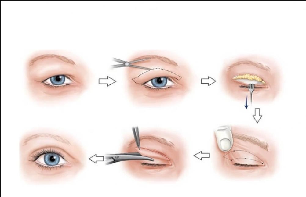 Tất tần tật từ A đến Á về phương pháp làm đẹp cắt mí Plasma