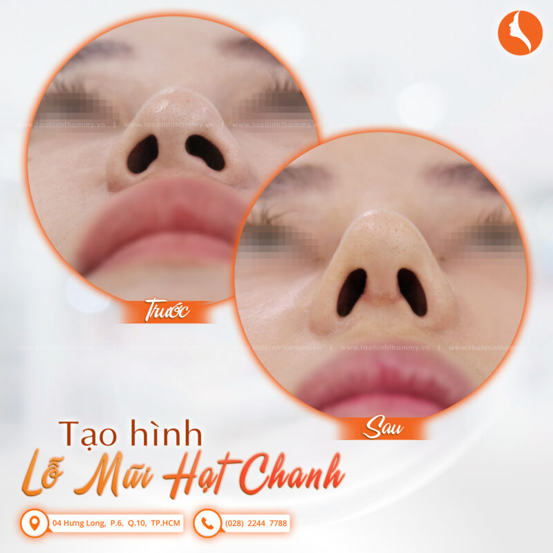 Lỗ mũi hạt chanh là như thế nào? Cách để sở hữu lỗ mũi hạt chanh đẹp tiêu chuẩn