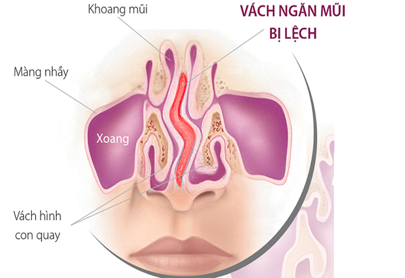 Mũi lệch vách ngăn là do đâu và khắc phục thế nào?