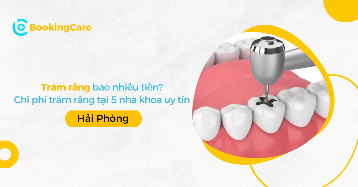 Trám răng bao nhiêu tiền? Chi phí trám răng tại 5 Nha khoa uy tín Hải Phòng