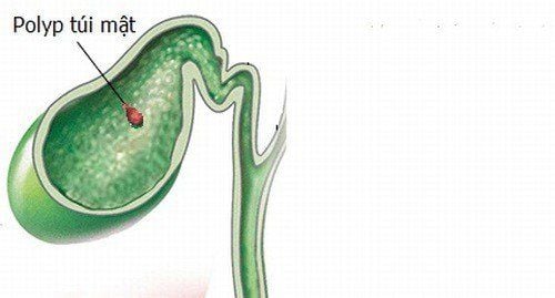 Polyp túi mật là bệnh gì và có cần phải điều trị không?