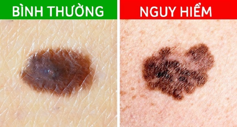 Nếu bạn đang có ý định tẩy nốt ruồi thì nên biết điều này